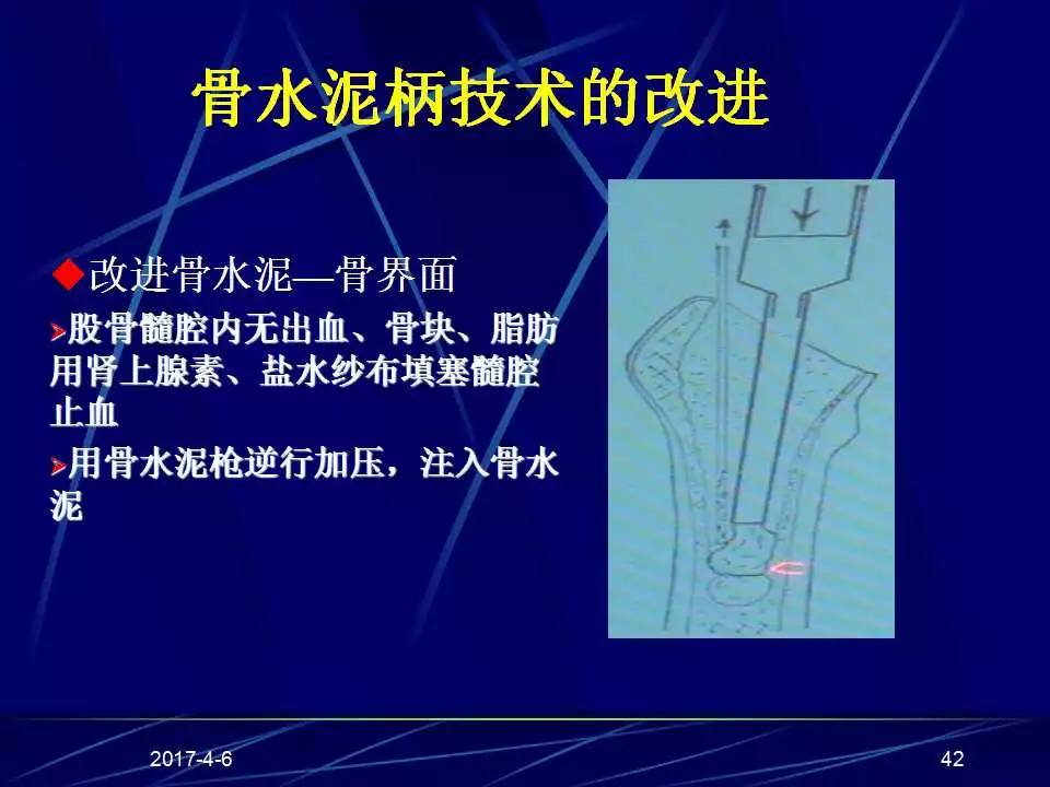 髋关节置换手术技巧及并发症的防范