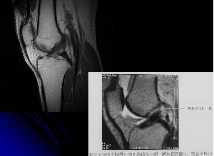 最全膝关节解剖及MRI诊断技巧