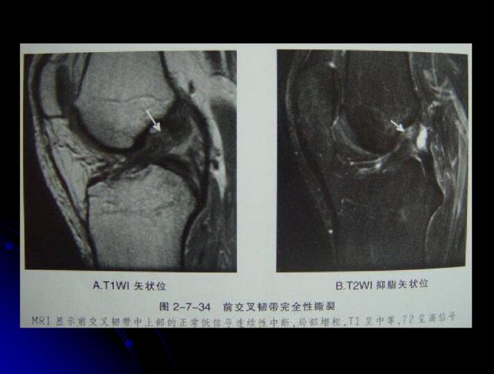 最全膝关节解剖及MRI诊断技巧