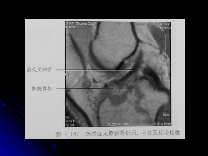 最全膝关节解剖及MRI诊断技巧