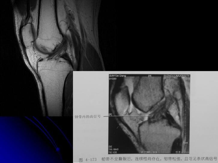 最全膝关节解剖及MRI诊断技巧