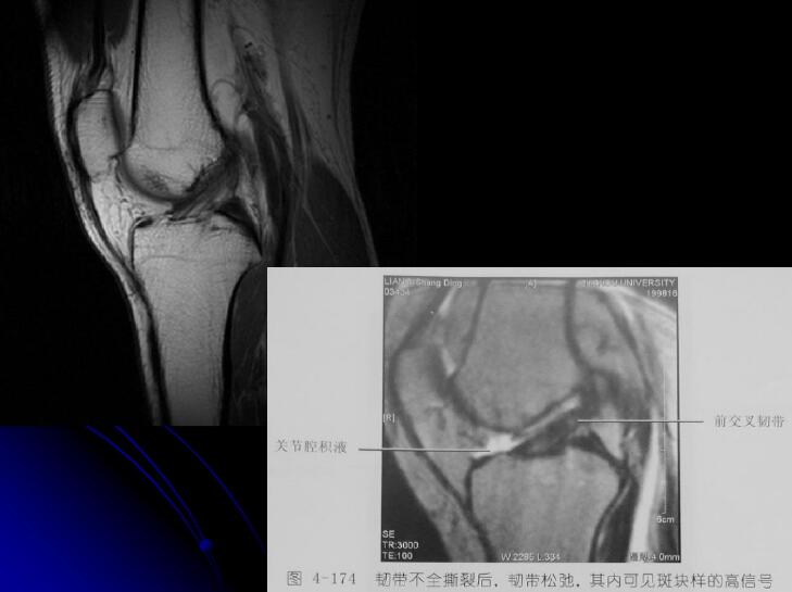 最全膝关节解剖及MRI诊断技巧