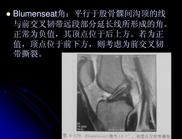 最全膝关节解剖及MRI诊断技巧