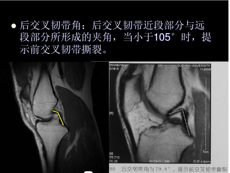 最全膝关节解剖及MRI诊断技巧