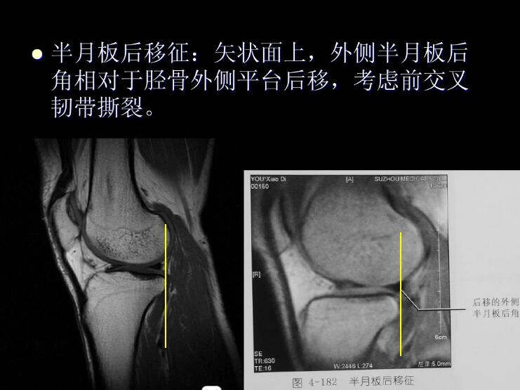 最全膝关节解剖及MRI诊断技巧