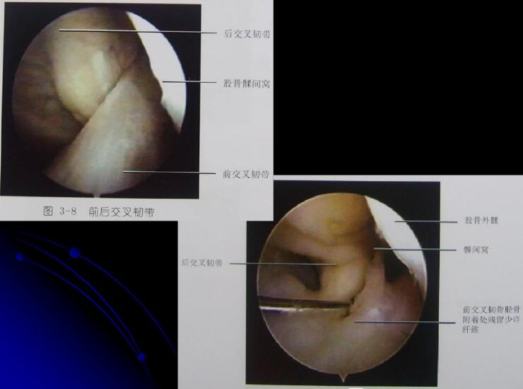 最全膝关节解剖及MRI诊断技巧