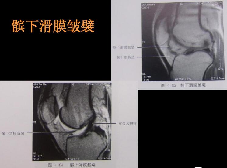 最全膝关节解剖及MRI诊断技巧