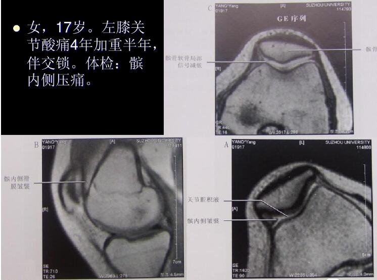 最全膝关节解剖及MRI诊断技巧