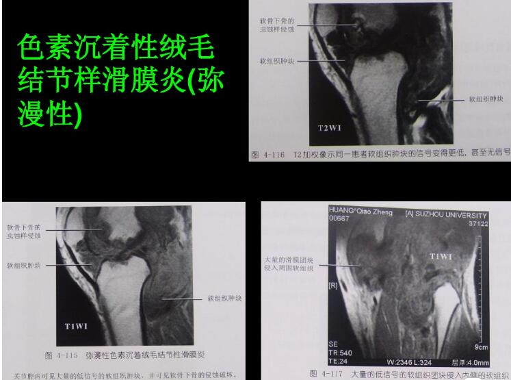 最全膝关节解剖及MRI诊断技巧