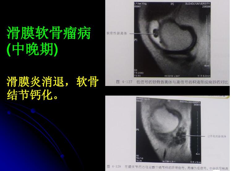 最全膝关节解剖及MRI诊断技巧