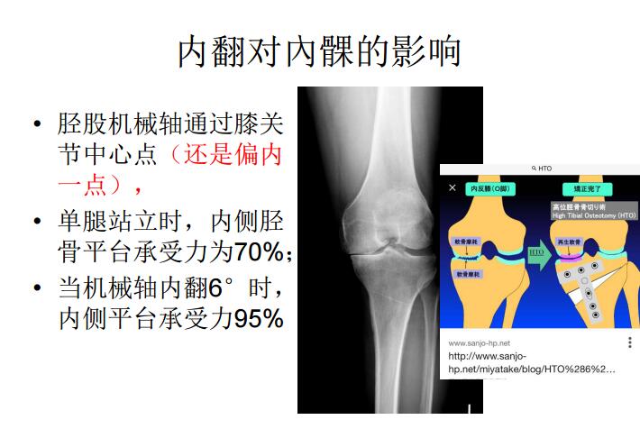 吴希瑞-关节OA疼原因