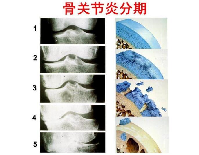 吴希瑞-关节OA疼原因