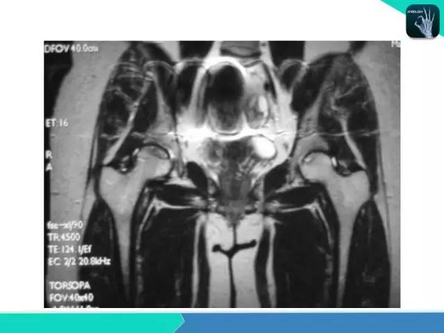 这个课件我想你需要！股骨头缺血性坏死的诊断