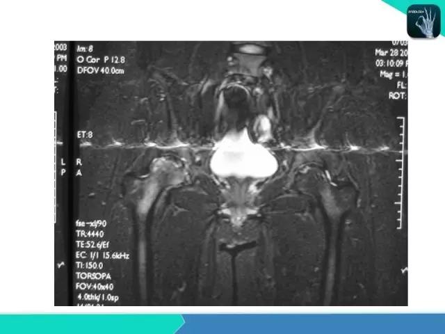 这个课件我想你需要！股骨头缺血性坏死的诊断