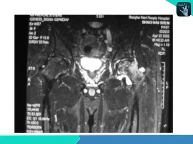 这个课件我想你需要！股骨头缺血性坏死的诊断
