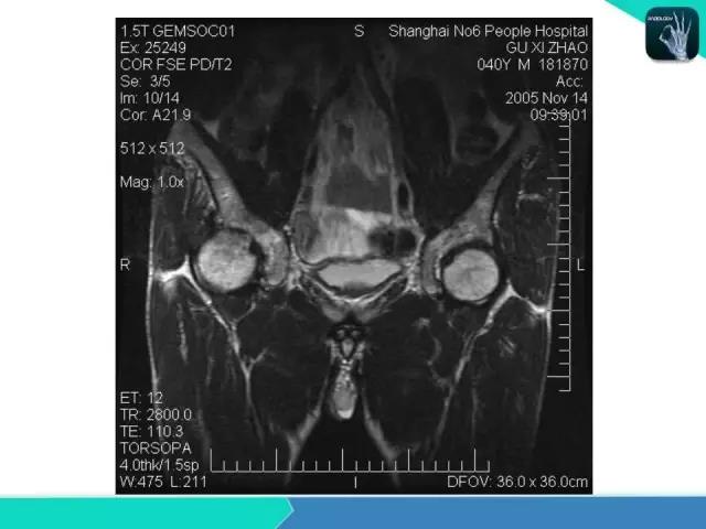 这个课件我想你需要！股骨头缺血性坏死的诊断