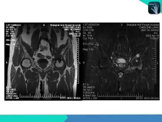 这个课件我想你需要！股骨头缺血性坏死的诊断