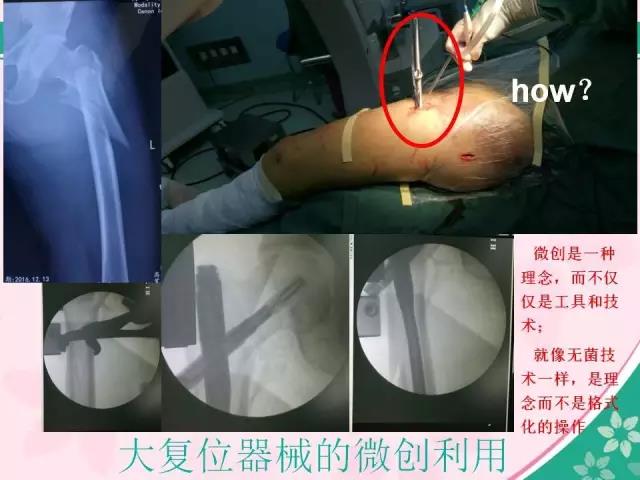 马永成：股骨近端骨折的治疗感悟