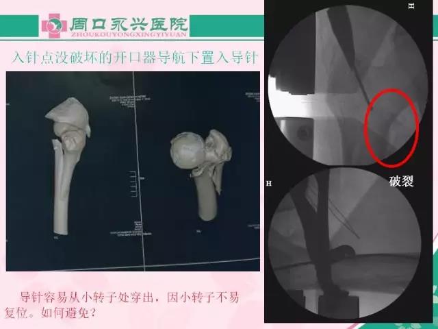 马永成：股骨近端骨折的治疗感悟