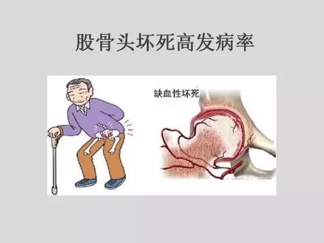 李培教授：冲击波疗法治疗股骨头坏死
