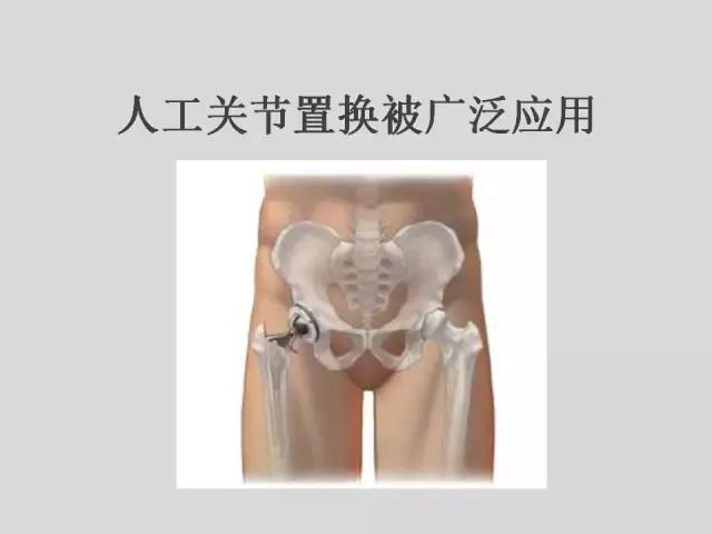 李培教授：冲击波疗法治疗股骨头坏死