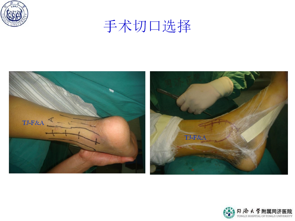 俞光荣-踝骨折的治疗策略