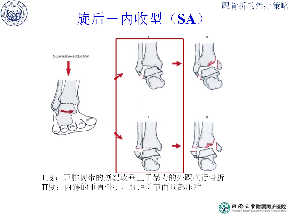 俞光荣-踝骨折的治疗策略