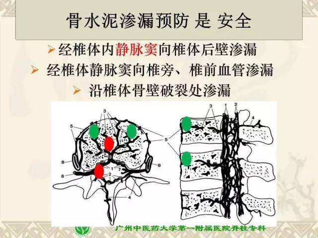 骨水泥椎弓根螺钉强化技术的安全流程