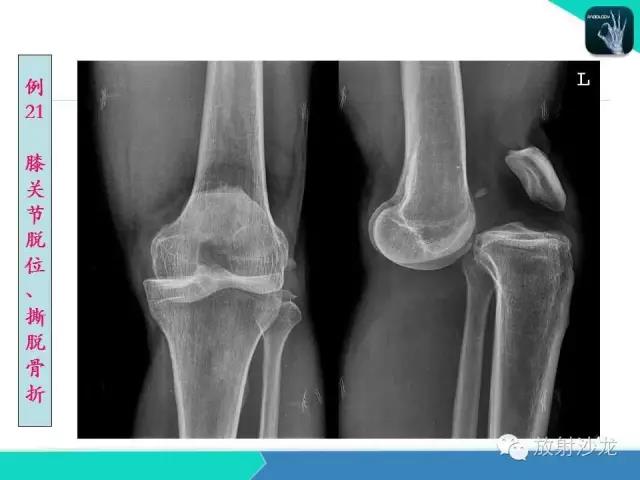 膝关节正常解剖及常见病变的影像表现