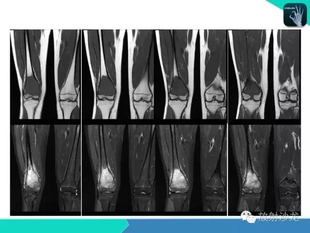 膝关节正常解剖及常见病变的影像表现