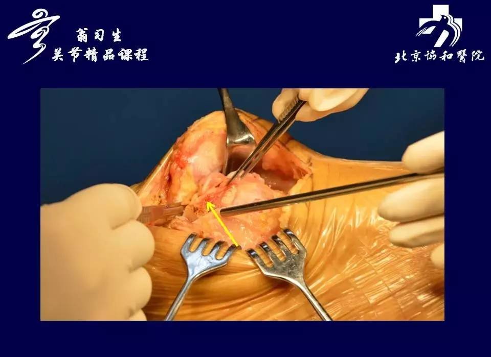 翁习生教授：人工全膝关节表面置换术—软组织处理篇