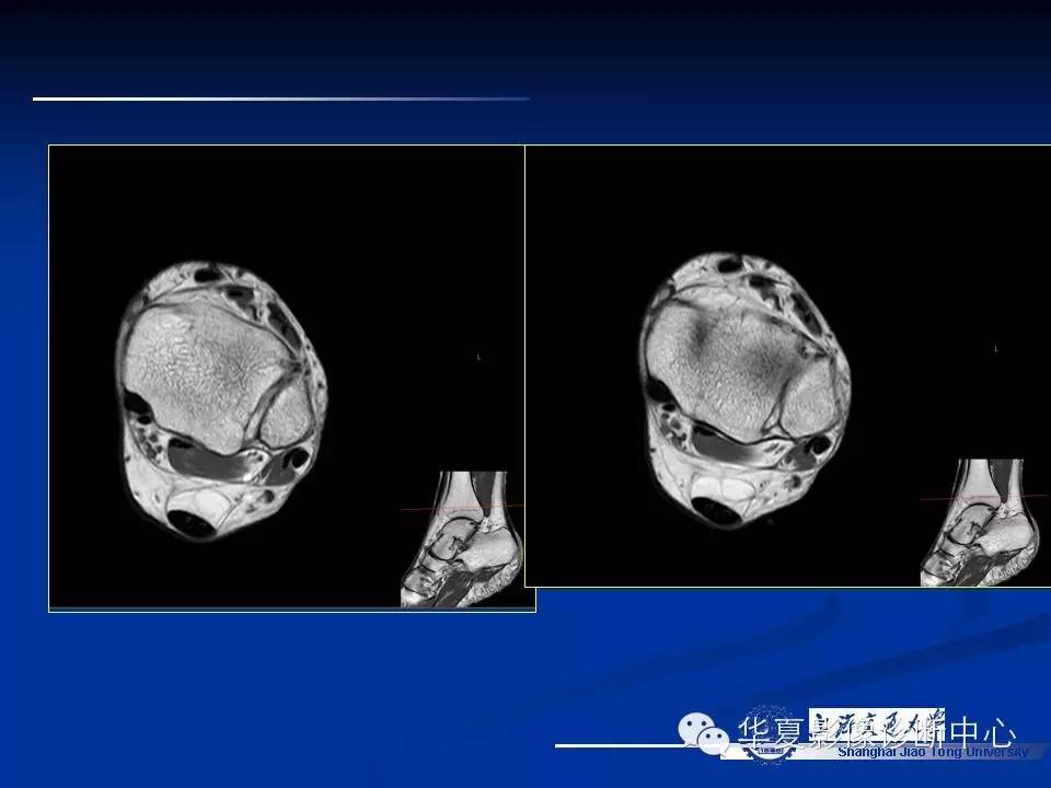 MRI在踝关节损伤中的应用