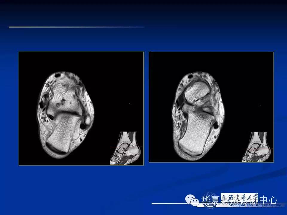 MRI在踝关节损伤中的应用