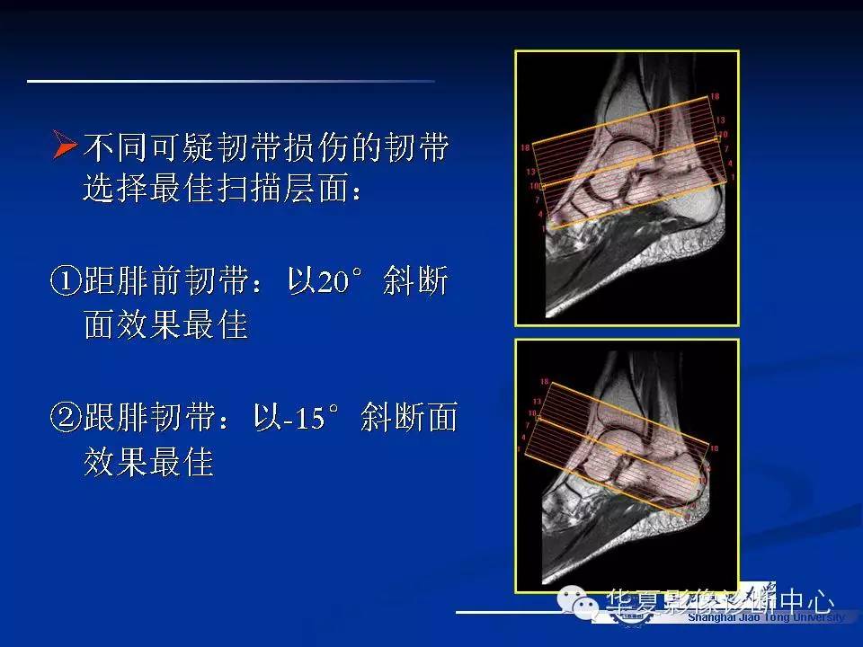 MRI在踝关节损伤中的应用