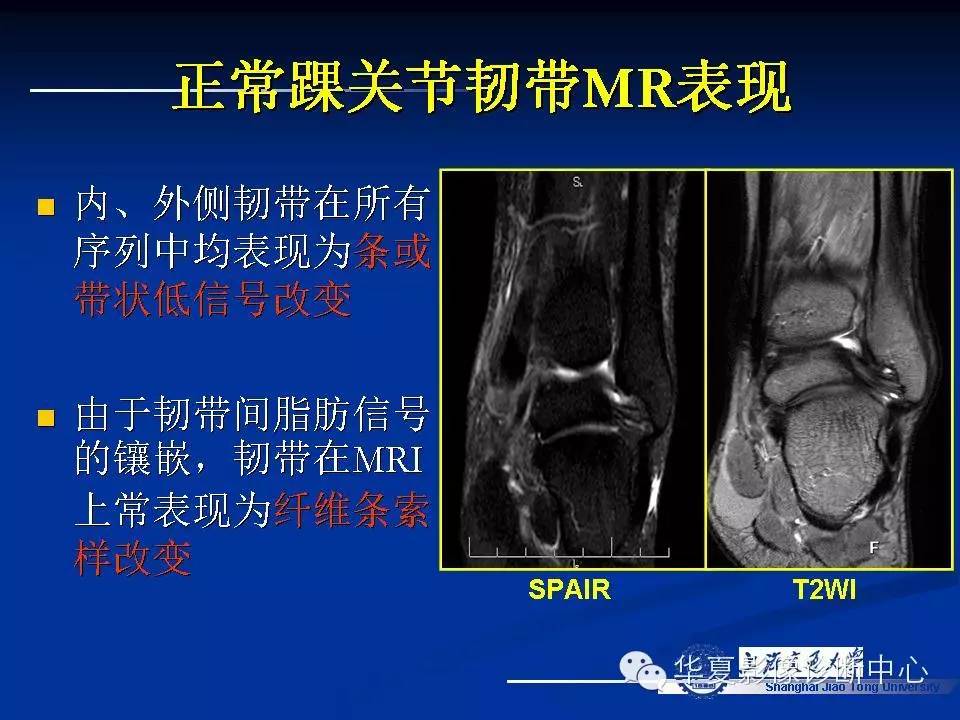 MRI在踝关节损伤中的应用