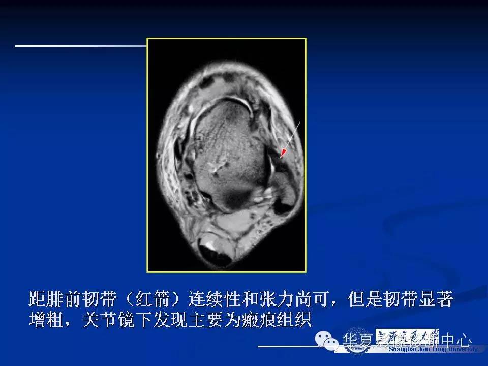 MRI在踝关节损伤中的应用