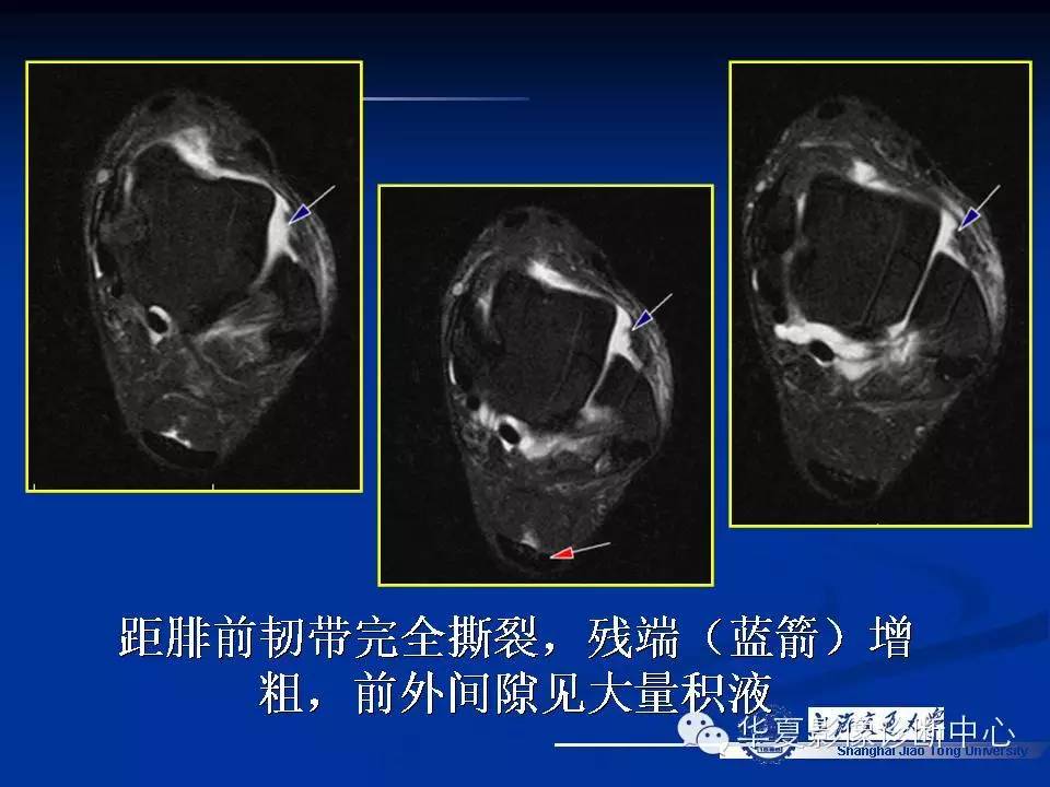 MRI在踝关节损伤中的应用