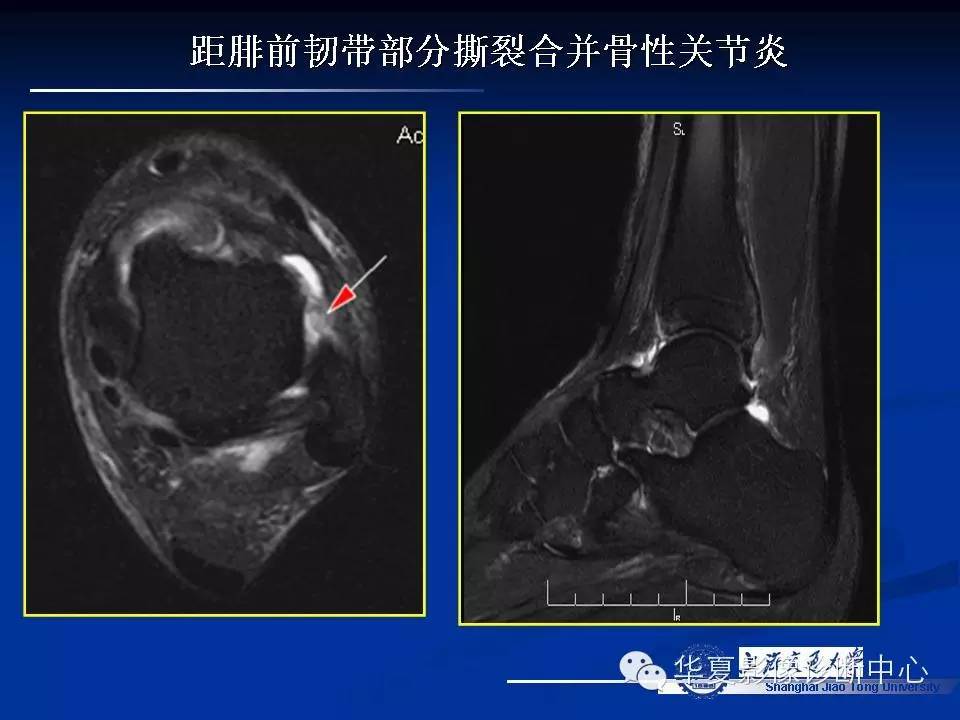 MRI在踝关节损伤中的应用