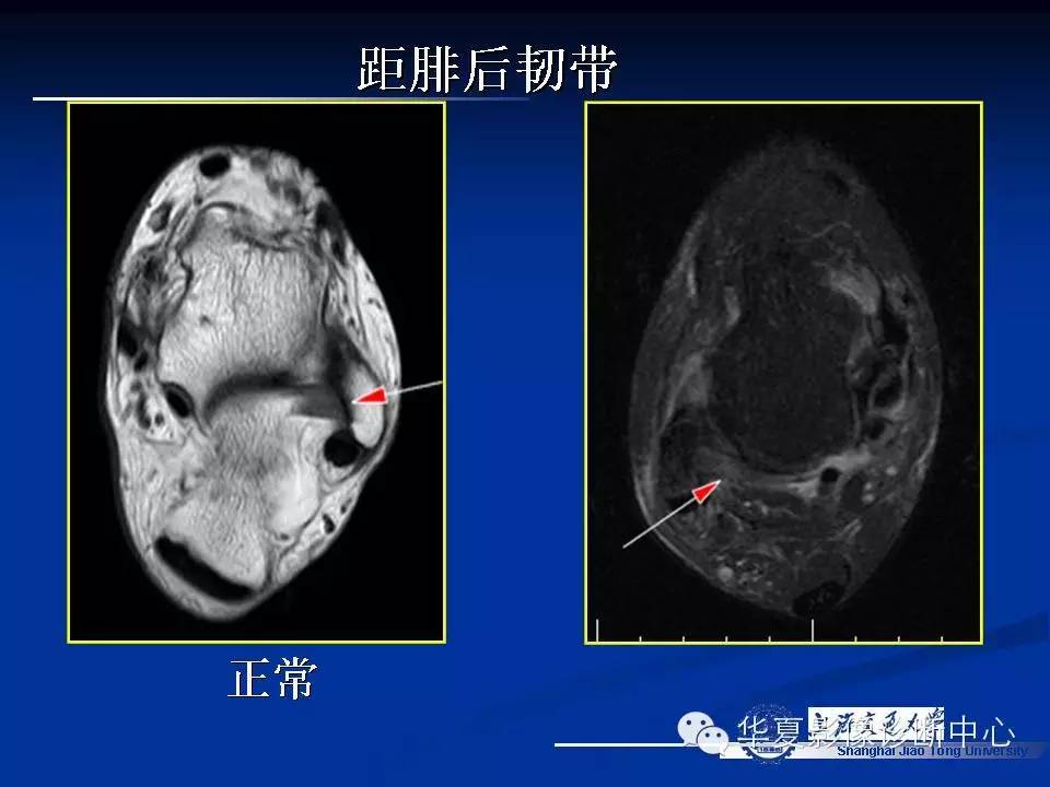 MRI在踝关节损伤中的应用