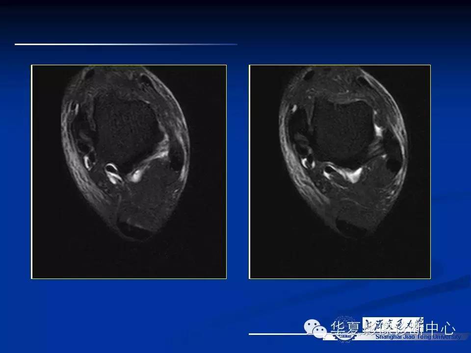 MRI在踝关节损伤中的应用