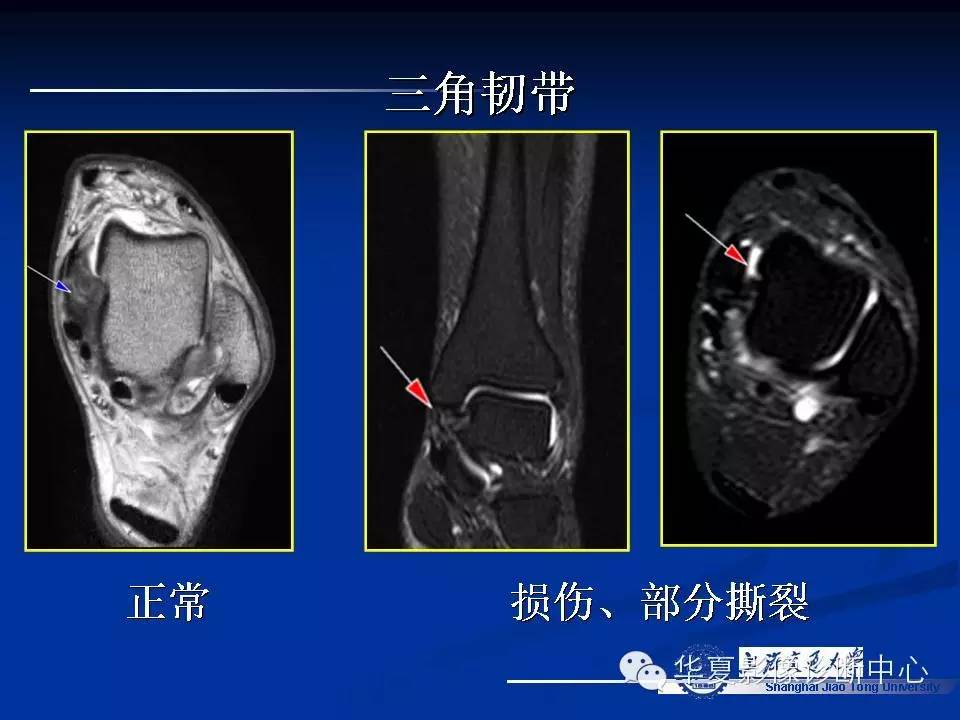 MRI在踝关节损伤中的应用