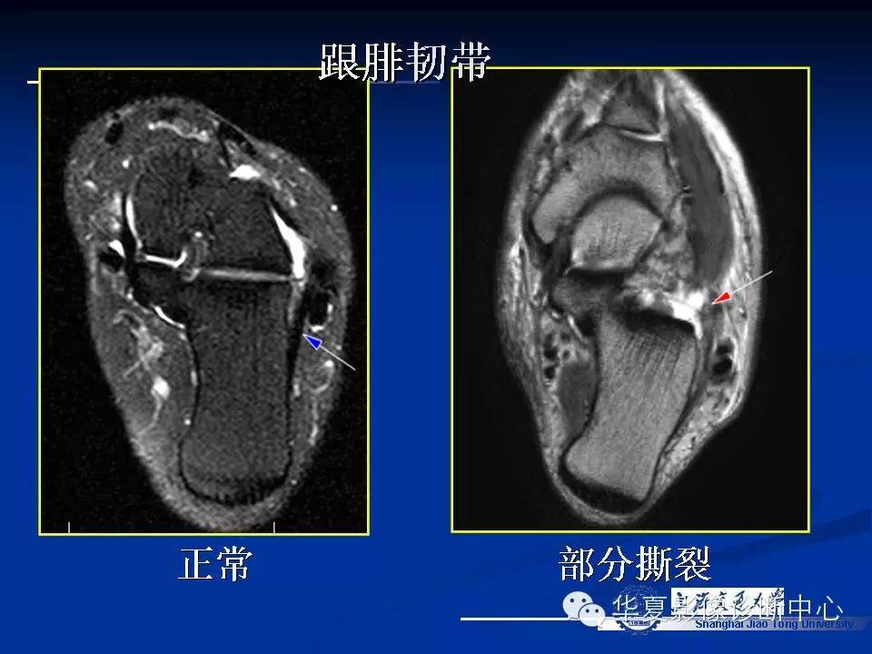 MRI在踝关节损伤中的应用