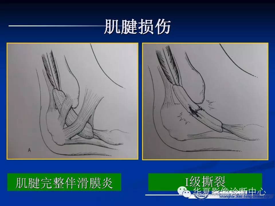 MRI在踝关节损伤中的应用