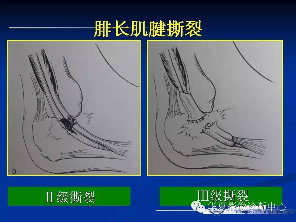 MRI在踝关节损伤中的应用