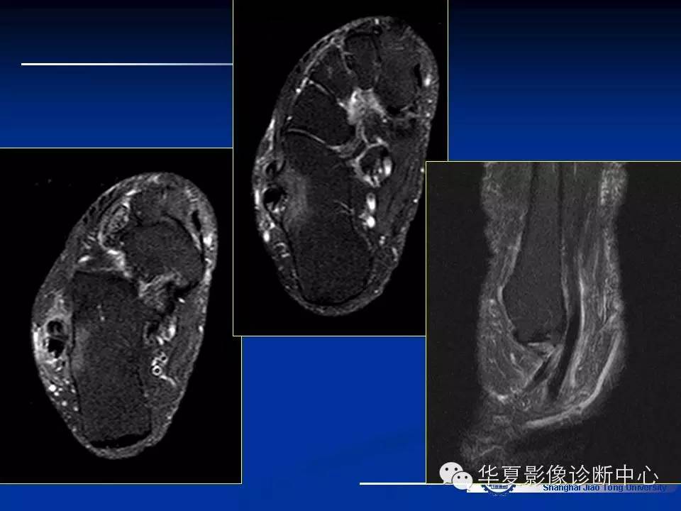 MRI在踝关节损伤中的应用