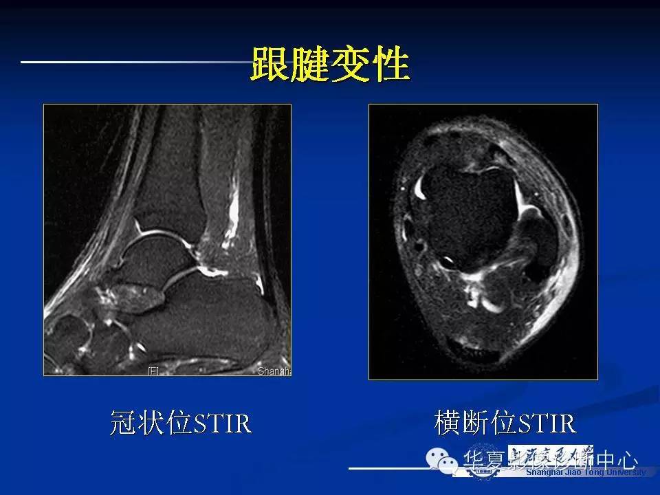 MRI在踝关节损伤中的应用