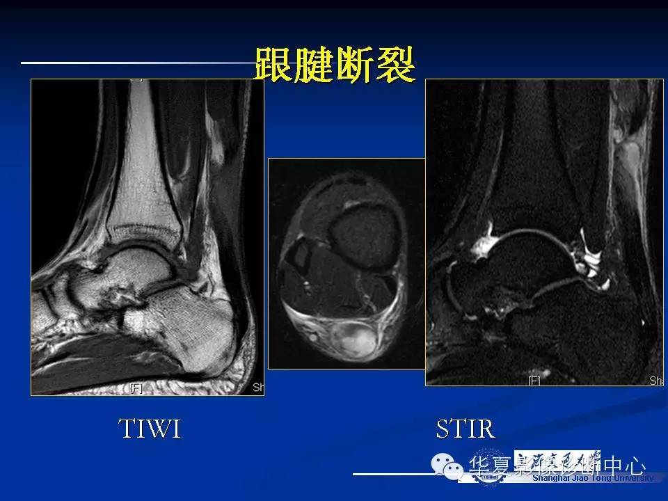 MRI在踝关节损伤中的应用