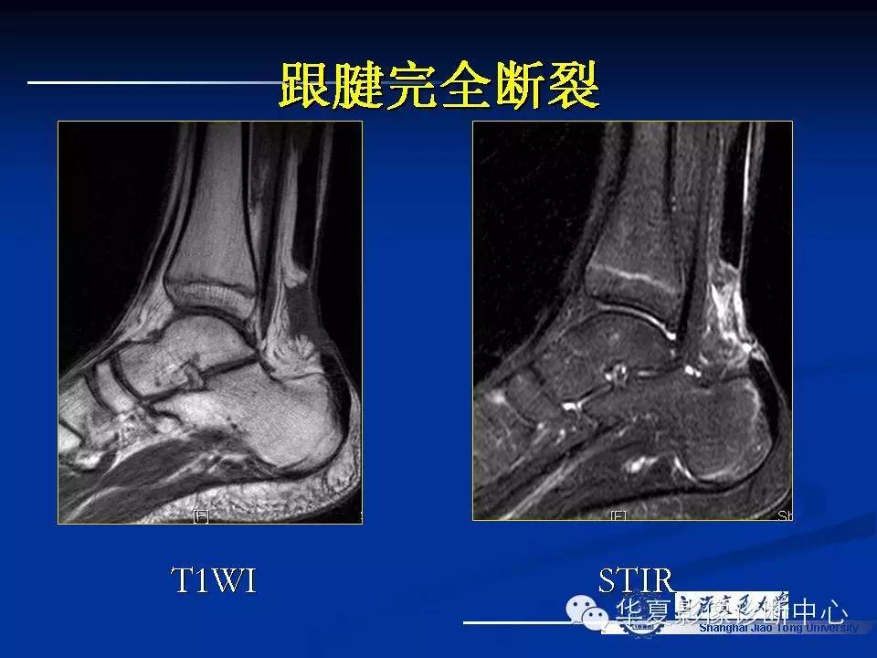 MRI在踝关节损伤中的应用