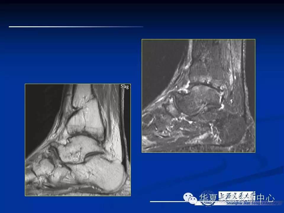 MRI在踝关节损伤中的应用