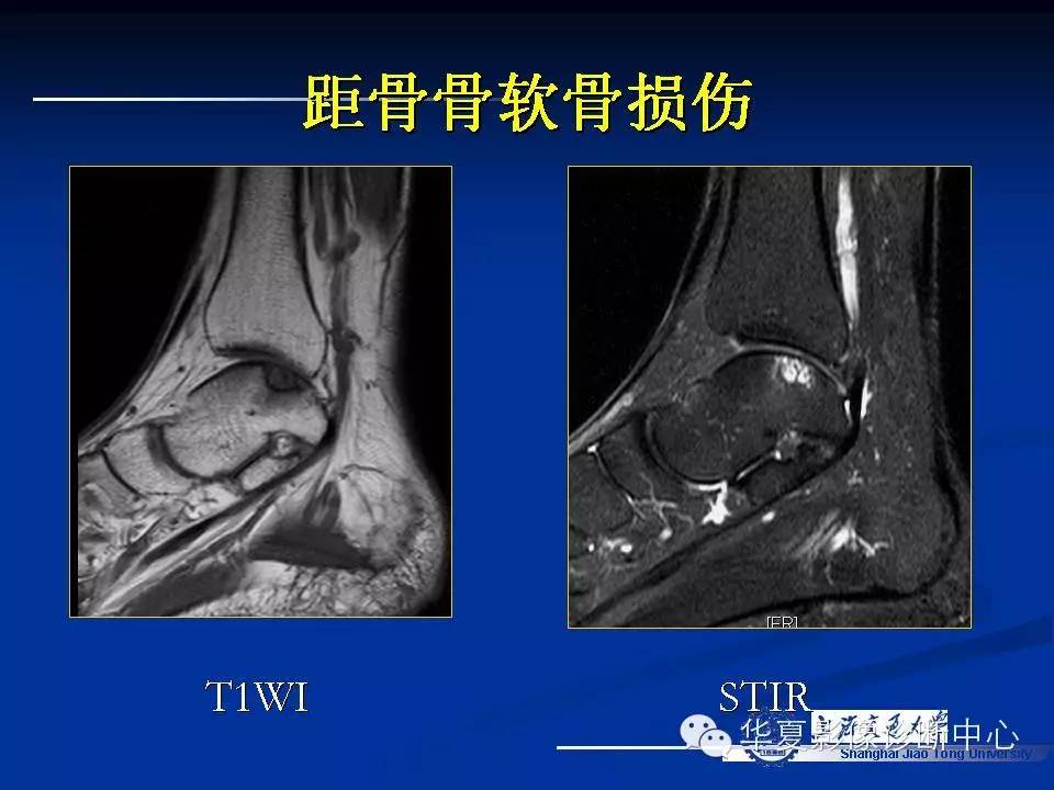 MRI在踝关节损伤中的应用